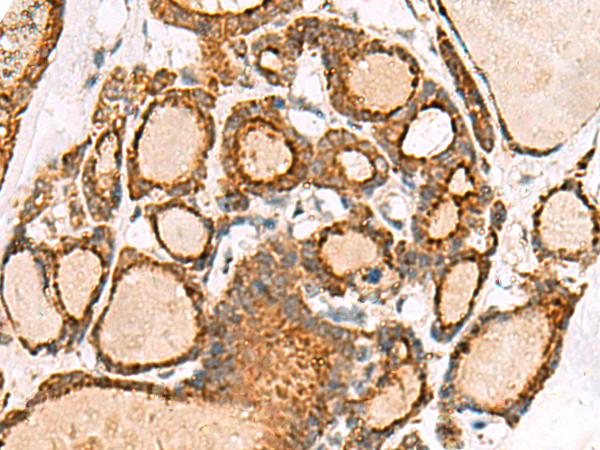 Immunohistochemistry of paraffin-embedded Human thyroid cancer tissue  using NPC2 Polyclonal Antibody at dilution of 1:50(×200)