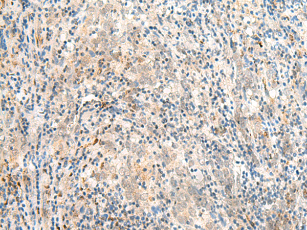 Immunohistochemistry of paraffin-embedded Human cervical cancer tissue  using JPT1 Polyclonal Antibody at dilution of 1:35(×200)