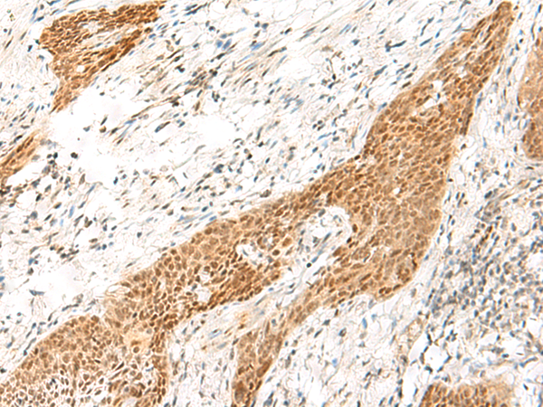 Immunohistochemistry of paraffin-embedded Human esophagus cancer tissue  using RPS27A Polyclonal Antibody at dilution of 1:35(×200)