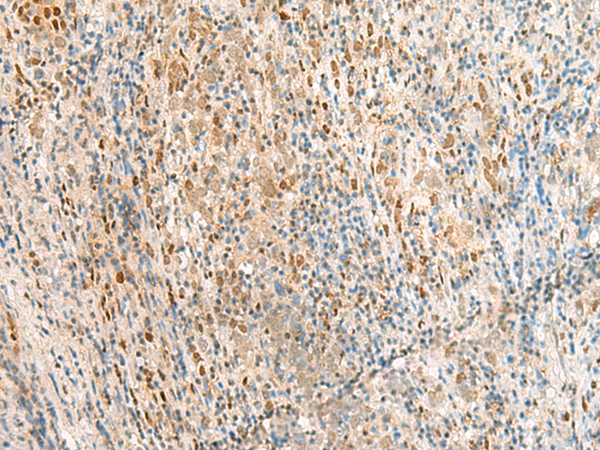 Immunohistochemistry of paraffin-embedded Human cervical cancer tissue  using RPS27A Polyclonal Antibody at dilution of 1:35(×200)