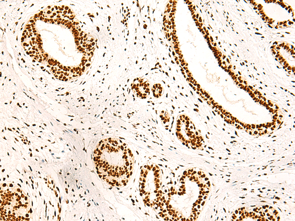 Immunohistochemistry of paraffin-embedded Human breast cancer tissue  using ILF3 Polyclonal Antibody at dilution of 1:40(×200)