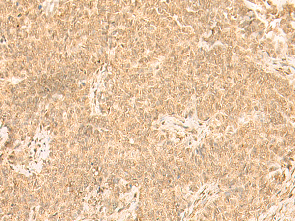 Immunohistochemistry of paraffin-embedded Human ovarian cancer tissue  using ST8SIA4 Polyclonal Antibody at dilution of 1:50(×200)