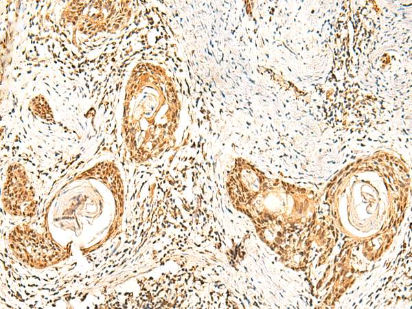 Immunohistochemistry of paraffin-embedded Human esophagus cancer tissue  using ZNF580 Polyclonal Antibody at dilution of 1:75(×200)