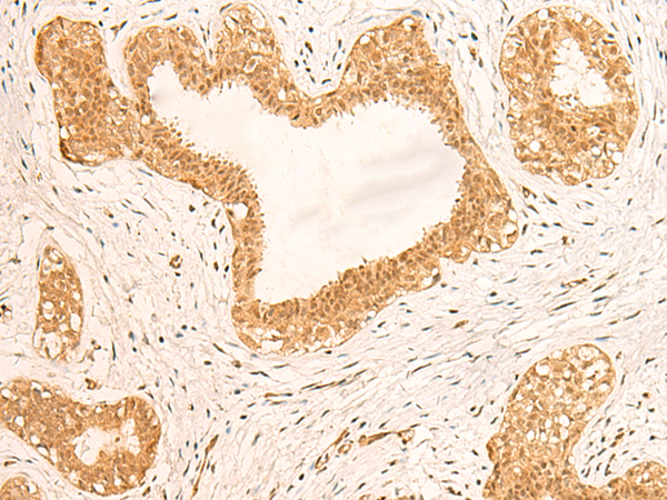 Immunohistochemistry of paraffin-embedded Human breast cancer tissue  using ZNF580 Polyclonal Antibody at dilution of 1:75(×200)