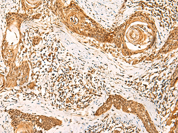 Immunohistochemistry of paraffin-embedded Human esophagus cancer tissue  using GSG1L Polyclonal Antibody at dilution of 1:50(×200)