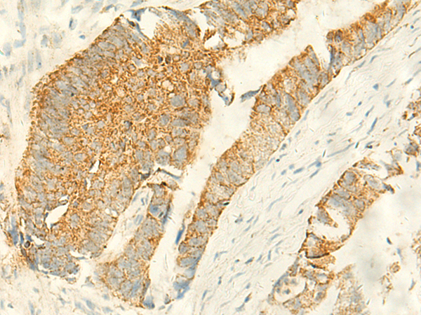 Immunohistochemistry of paraffin-embedded Human colorectal cancer tissue  using MPV17 Polyclonal Antibody at dilution of 1:50(×200)