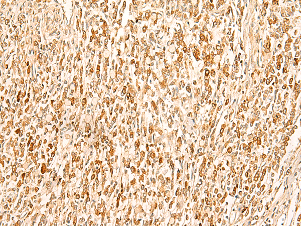 Immunohistochemistry of paraffin-embedded Human gastric cancer tissue  using SMUG1 Polyclonal Antibody at dilution of 1:50(×200)