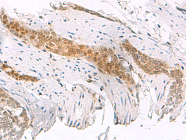 Immunohistochemistry of paraffin-embedded Human esophagus cancer tissue  using SCAND1 Polyclonal Antibody at dilution of 1:50(×200)