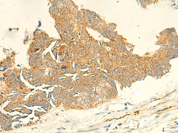 Immunohistochemistry of paraffin-embedded Human colorectal cancer tissue  using TMEM9 Polyclonal Antibody at dilution of 1:50(×200)