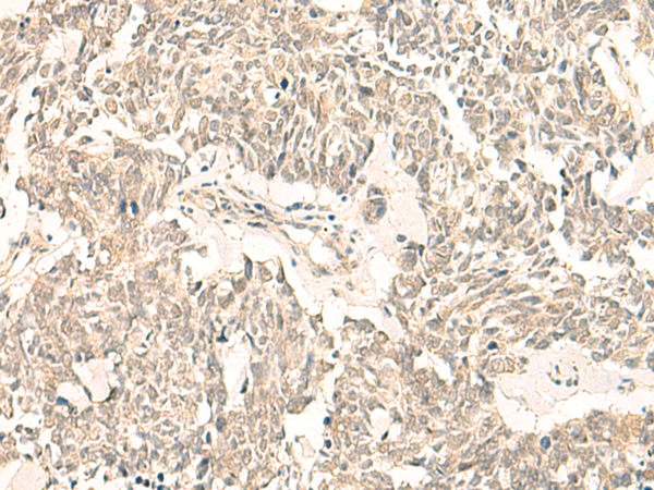 Immunohistochemistry of paraffin-embedded Human lung cancer tissue  using GINS2 Polyclonal Antibody at dilution of 1:50(×200)