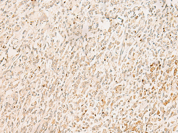 Immunohistochemistry of paraffin-embedded Human gastric cancer tissue  using GINS2 Polyclonal Antibody at dilution of 1:50(×200)