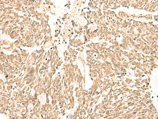 Immunohistochemistry of paraffin-embedded Human lung cancer tissue  using TBPL1 Polyclonal Antibody at dilution of 1:50(×200)