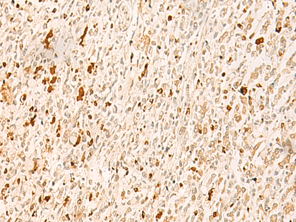 Immunohistochemistry of paraffin-embedded Human gastric cancer tissue  using TBPL1 Polyclonal Antibody at dilution of 1:50(×200)