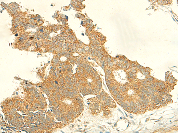 Immunohistochemistry of paraffin-embedded Human colorectal cancer tissue  using IFT27 Polyclonal Antibody at dilution of 1:50(×200)