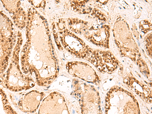 Immunohistochemistry of paraffin-embedded Human thyroid cancer tissue  using FUNDC2 Polyclonal Antibody at dilution of 1:60(×200)