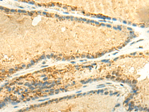 Immunohistochemistry of paraffin-embedded Human thyroid cancer tissue  using EEF1AKMT2 Polyclonal Antibody at dilution of 1:50(×200)