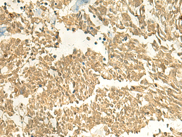 Immunohistochemistry of paraffin-embedded Human lung cancer tissue  using EEF1AKMT2 Polyclonal Antibody at dilution of 1:50(×200)