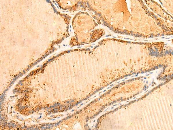 Immunohistochemistry of paraffin-embedded Human thyroid cancer tissue  using PPM1B Polyclonal Antibody at dilution of 1:50(×200)