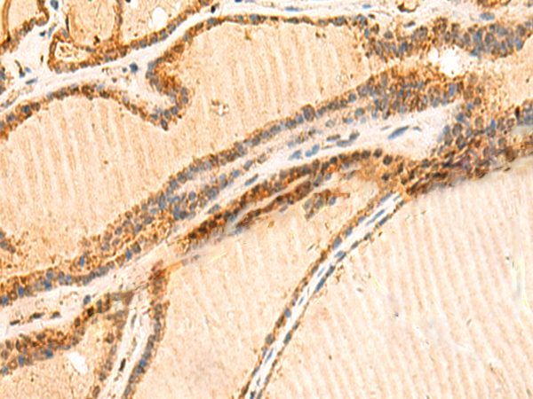 Immunohistochemistry of paraffin-embedded Human thyroid cancer tissue  using LYZL1 Polyclonal Antibody at dilution of 1:50(×200)