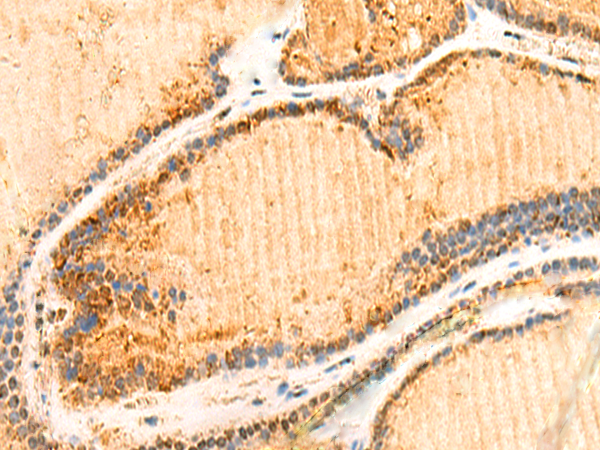 Immunohistochemistry of paraffin-embedded Human thyroid cancer tissue  using ZNF581 Polyclonal Antibody at dilution of 1:50(×200)