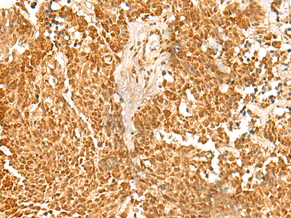 Immunohistochemistry of paraffin-embedded Human lung cancer tissue  using SSSCA1 Polyclonal Antibody at dilution of 1:50(×200)
