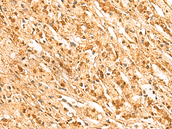 Immunohistochemistry of paraffin-embedded Human prost ate cancer tissue  using SSSCA1 Polyclonal Antibody at dilution of 1:50(×200)