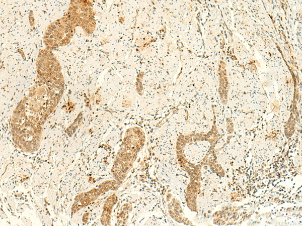 Immunohistochemistry of paraffin-embedded Human esophagus cancer tissue  using ARL4D Polyclonal Antibody at dilution of 1:50(×200)