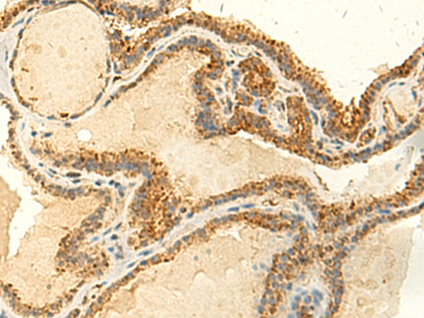 Immunohistochemistry of paraffin-embedded Human thyroid cancer tissue  using MTHFS Polyclonal Antibody at dilution of 1:50(×200)