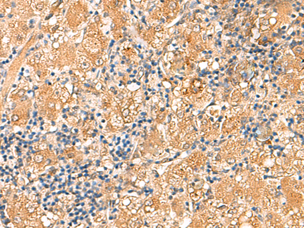 Immunohistochemistry of paraffin-embedded Human liver cancer tissue  using RPL13A Polyclonal Antibody at dilution of 1:60(×200)