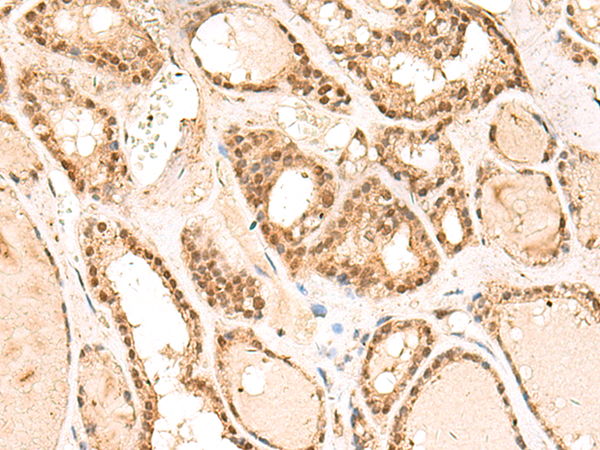 Immunohistochemistry of paraffin-embedded Human thyroid cancer tissue  using RPL13A Polyclonal Antibody at dilution of 1:60(×200)