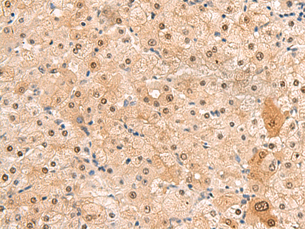 Immunohistochemistry of paraffin-embedded Human liver cancer tissue  using HEBP2 Polyclonal Antibody at dilution of 1:60(×200)