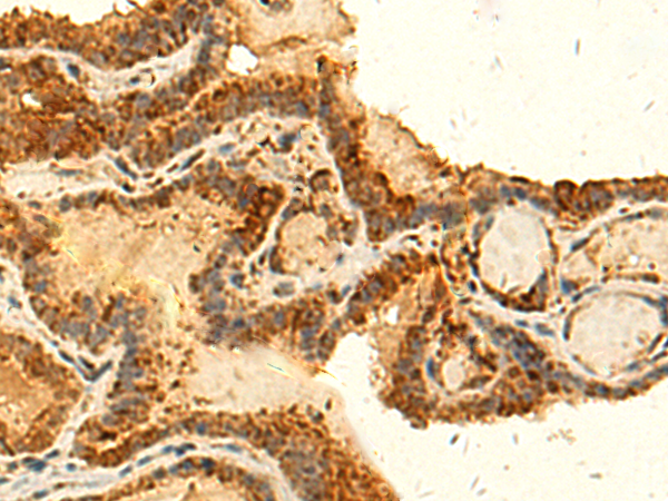 Immunohistochemistry of paraffin-embedded Human thyroid cancer tissue  using HS1BP3 Polyclonal Antibody at dilution of 1:50(×200)
