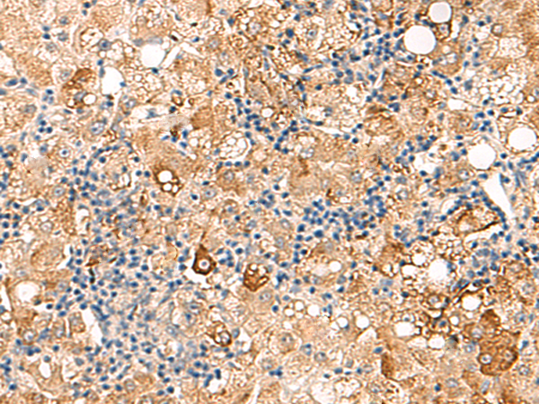 Immunohistochemistry of paraffin-embedded Human liver cancer tissue  using SEC22B Polyclonal Antibody at dilution of 1:70(×200)