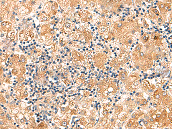 Immunohistochemistry of paraffin-embedded Human liver cancer tissue  using EIF3K Polyclonal Antibody at dilution of 1:75(×200)