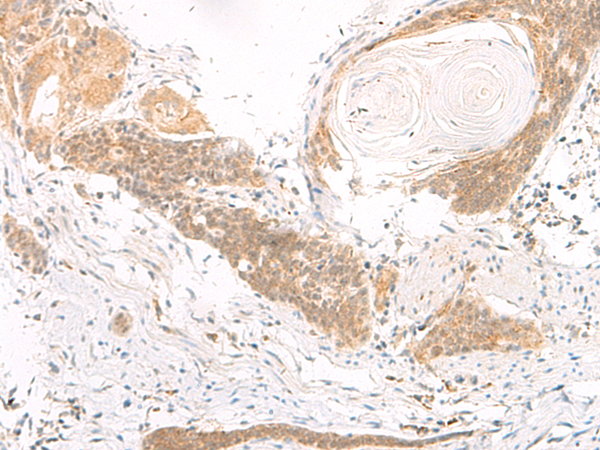 Immunohistochemistry of paraffin-embedded Human esophagus cancer tissue  using DGCR6L Polyclonal Antibody at dilution of 1:70(×200)