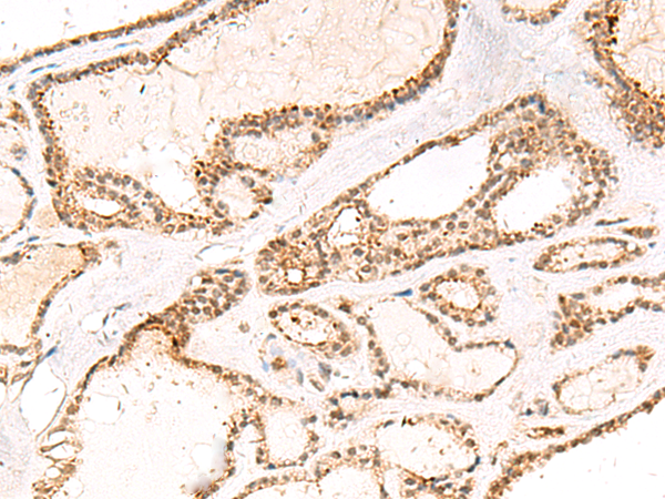 Immunohistochemistry of paraffin-embedded Human thyroid cancer tissue  using DCAF10 Polyclonal Antibody at dilution of 1:55(×200)