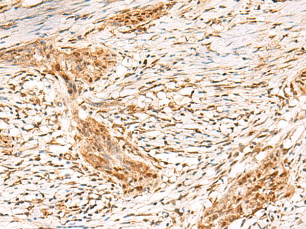 Immunohistochemistry of paraffin-embedded Human esophagus cancer tissue  using DCAF10 Polyclonal Antibody at dilution of 1:55(×200)