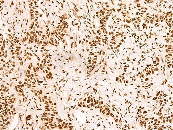 Immunohistochemistry of paraffin-embedded Human ovarian cancer tissue  using SNRPB2 Polyclonal Antibody at dilution of 1:90(×200)