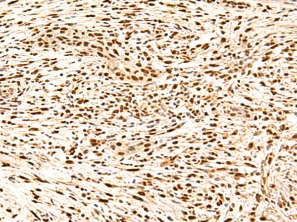 Immunohistochemistry of paraffin-embedded Human esophagus cancer tissue  using SNRPB2 Polyclonal Antibody at dilution of 1:90(×200)