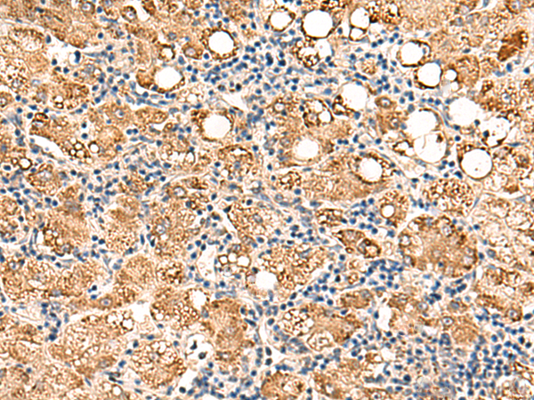 Immunohistochemistry of paraffin-embedded Human gastric cancer tissue  using NEGR1 Polyclonal Antibody at dilution of 1:50(×200)