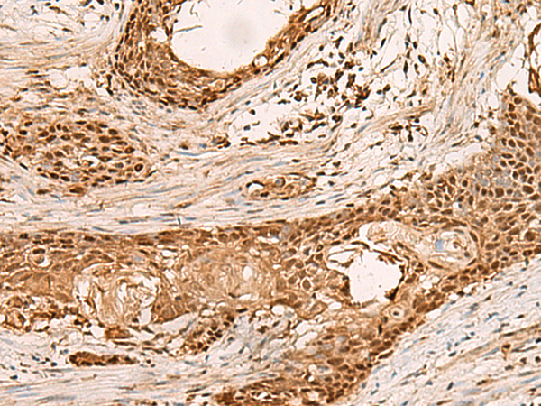 Immunohistochemistry of paraffin-embedded Human esophagus cancer tissue  using PAFAH1B2 Polyclonal Antibody at dilution of 1:50(×200)