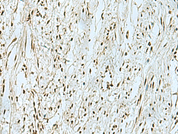 Immunohistochemistry of paraffin-embedded Human breast cancer tissue  using THTPA Polyclonal Antibody at dilution of 1:90(×200)