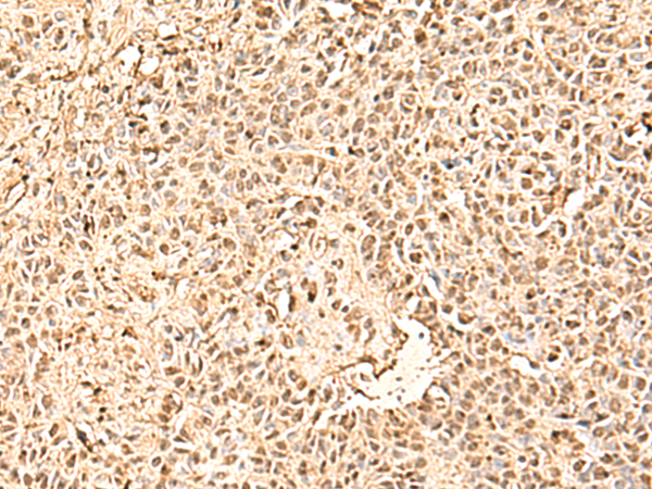 Immunohistochemistry of paraffin-embedded Human ovarian cancer tissue  using SMNDC1 Polyclonal Antibody at dilution of 1:50(×200)