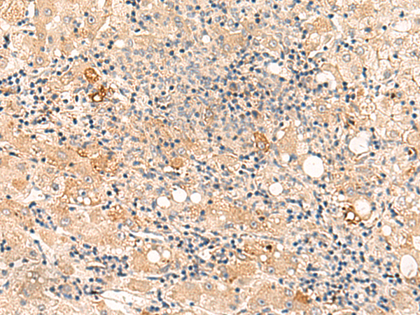 Immunohistochemistry of paraffin-embedded Human liver cancer tissue  using SULT4A1 Polyclonal Antibody at dilution of 1:50(×200)