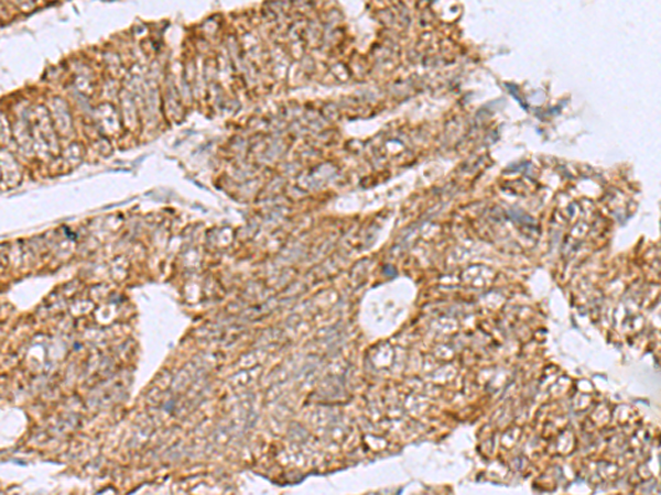 Immunohistochemistry of paraffin-embedded Human colorectal cancer tissue  using HCCS Polyclonal Antibody at dilution of 1:60(×200)