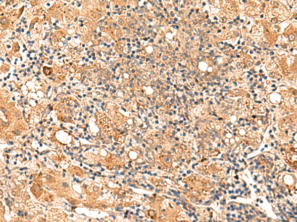 Immunohistochemistry of paraffin-embedded Human liver cancer tissue  using GALNT12 Polyclonal Antibody at dilution of 1:70(×200)