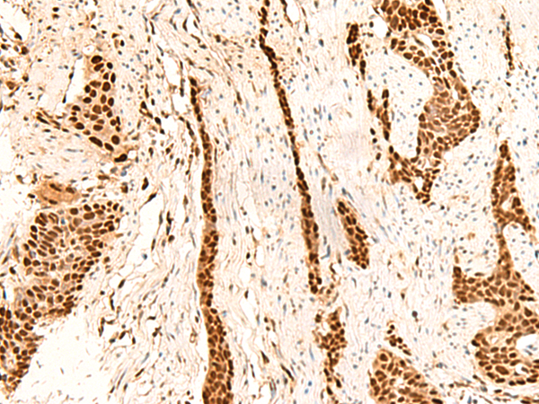 Immunohistochemistry of paraffin-embedded Human esophagus cancer tissue  using METTL1 Polyclonal Antibody at dilution of 1:55(×200)