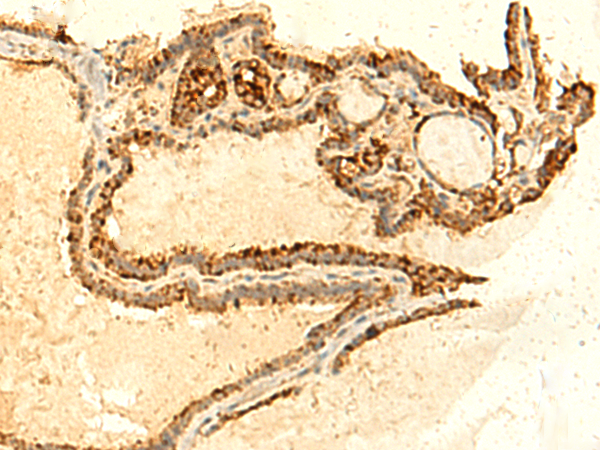 Immunohistochemistry of paraffin-embedded Human thyroid cancer tissue  using UNKL Polyclonal Antibody at dilution of 1:50(×200)