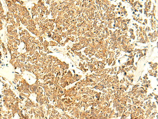 Immunohistochemistry of paraffin-embedded Human lung cancer tissue  using UNKL Polyclonal Antibody at dilution of 1:50(×200)