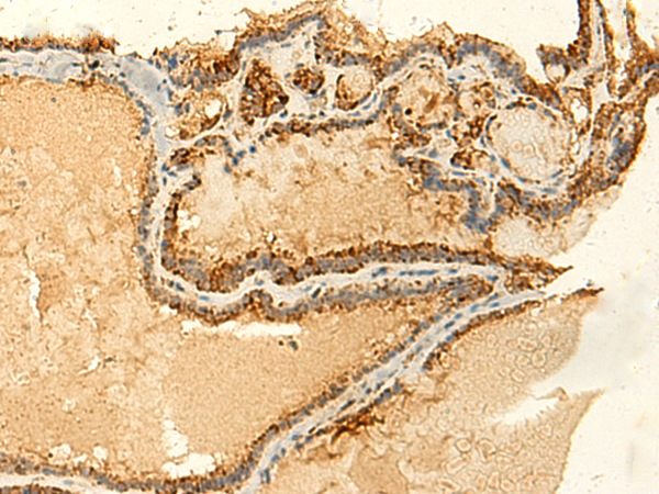 Immunohistochemistry of paraffin-embedded Human thyroid cancer tissue  using GLYATL2 Polyclonal Antibody at dilution of 1:50(×200)